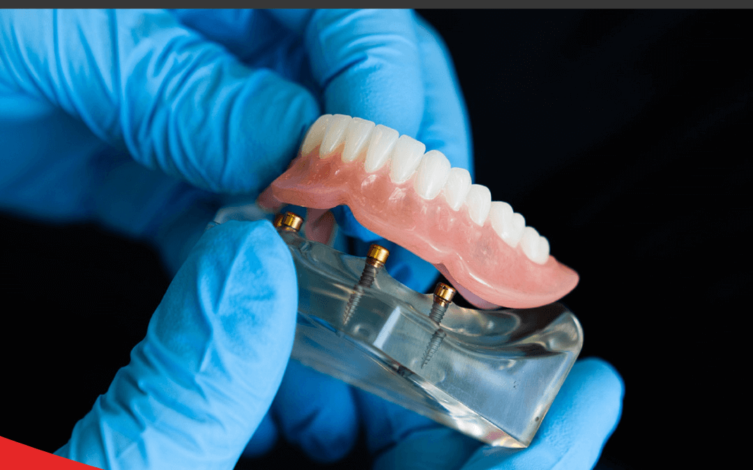 Dental Implants vs. Dentures: Which Option Is Right for You?